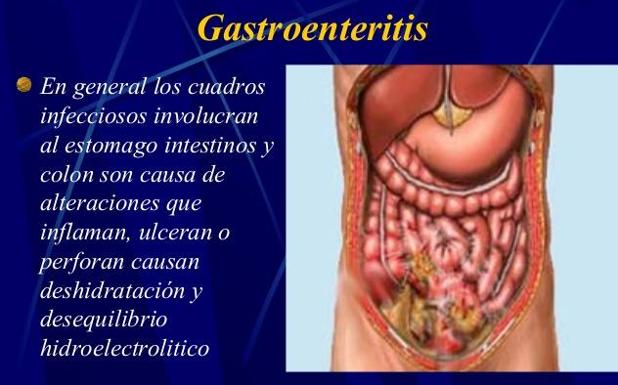 Dieta para gastroenteritis sin diarrea